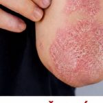 Nikad više nećete baciti koru od ove voćke: liječI psorijazu, skida bradavice I izbjeljuje zube Nikad više nećete baciti koru od ove voćke: liječI psorijazu, skida bradavice I izbjeljuje zube - featured image