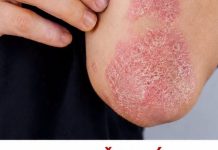 Nikad više nećete baciti koru od ove voćke: liječI psorijazu, skida bradavice I izbjeljuje zube Nikad više nećete baciti koru od ove voćke: liječI psorijazu, skida bradavice I izbjeljuje zube - featured image
