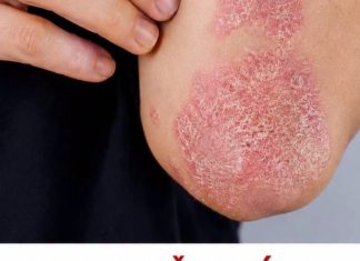 Nikad više nećete baciti koru od ove voćke: liječI psorijazu, skida bradavice I izbjeljuje zube Nikad više nećete baciti koru od ove voćke: liječI psorijazu, skida bradavice I izbjeljuje zube - featured image