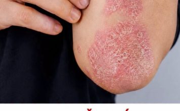 Nikad više nećete baciti koru od ove voćke: liječI psorijazu, skida bradavice I izbjeljuje zube Nikad više nećete baciti koru od ove voćke: liječI psorijazu, skida bradavice I izbjeljuje zube - featured image