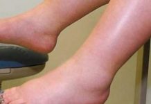 DA IZBACITE VIŠAK VODE POTREBAN VAM JE JEDAN VITAMIN: Ni noge vam više neće oticati, samo ga ubacite u ishranu DA IZBACITE VIŠAK VODE POTREBAN VAM JE JEDAN VITAMIN: Ni noge vam više neće oticati, samo ga ubacite u ishranu - featured image