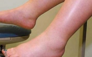 DA IZBACITE VIŠAK VODE POTREBAN VAM JE JEDAN VITAMIN: Ni noge vam više neće oticati, samo ga ubacite u ishranu DA IZBACITE VIŠAK VODE POTREBAN VAM JE JEDAN VITAMIN: Ni noge vam više neće oticati, samo ga ubacite u ishranu - featured image