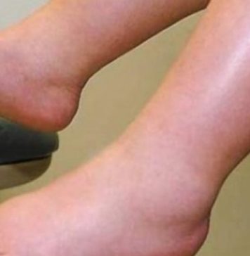 DA IZBACITE VIŠAK VODE POTREBAN VAM JE JEDAN VITAMIN: Ni noge vam više neće oticati, samo ga ubacite u ishranu DA IZBACITE VIŠAK VODE POTREBAN VAM JE JEDAN VITAMIN: Ni noge vam više neće oticati, samo ga ubacite u ishranu - featured image