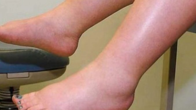 DA IZBACITE VIŠAK VODE POTREBAN VAM JE JEDAN VITAMIN: Ni noge vam više neće oticati, samo ga ubacite u ishranu - featured image DA IZBACITE VIŠAK VODE POTREBAN VAM JE JEDAN VITAMIN: Ni noge vam više neće oticati, samo ga ubacite u ishranu - featured image