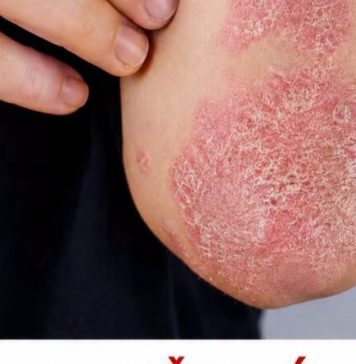 Nikad više nećete baciti koru od ove voćke: liječI psorijazu, skida bradavice I izbjeljuje zube Nikad više nećete baciti koru od ove voćke: liječI psorijazu, skida bradavice I izbjeljuje zube - featured image