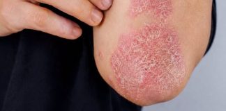 Nikad više nećete baciti koru od ove voćke: liječI psorijazu, skida bradavice I izbjeljuje zube Nikad više nećete baciti koru od ove voćke: liječI psorijazu, skida bradavice I izbjeljuje zube - featured image
